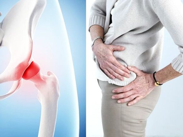 Аломатҳои артрози артрози буғуми HIP